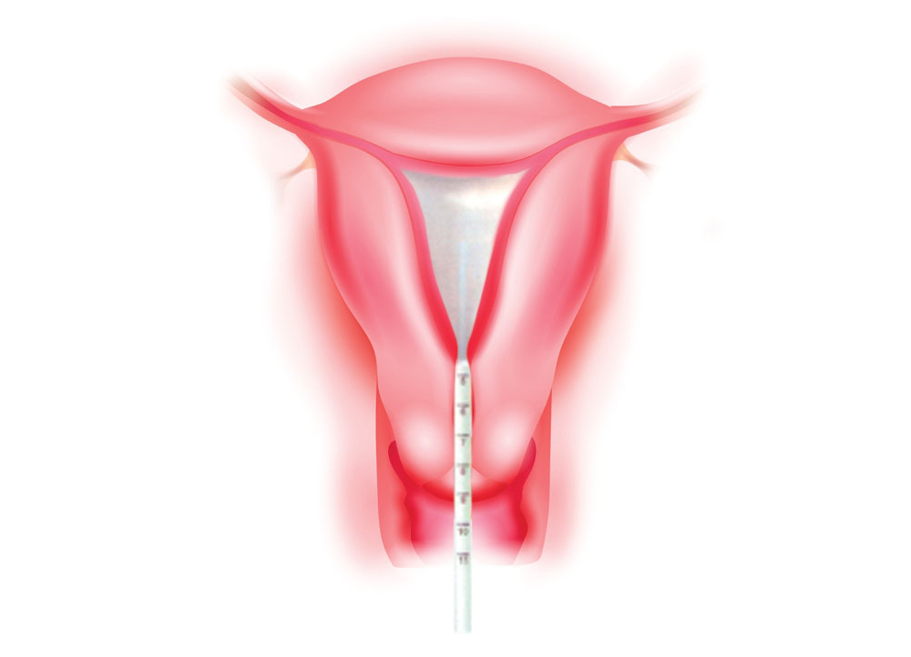 Thermablate Uterus Balloon