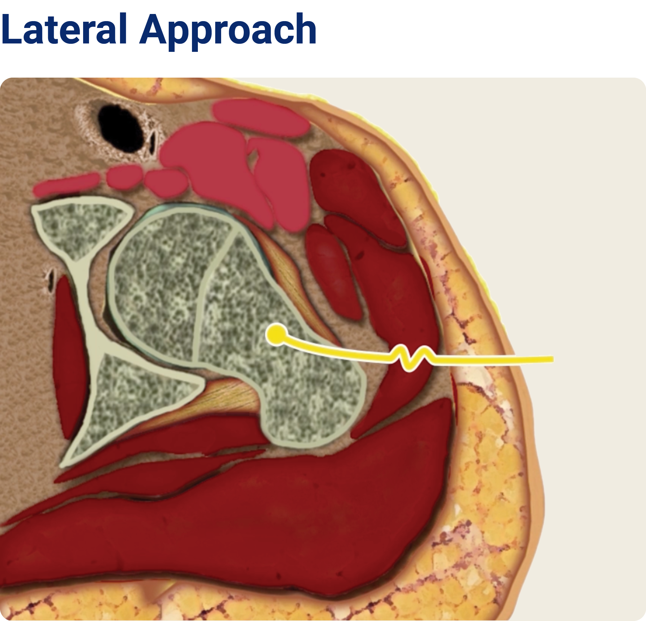 THA Approaches Lateral
